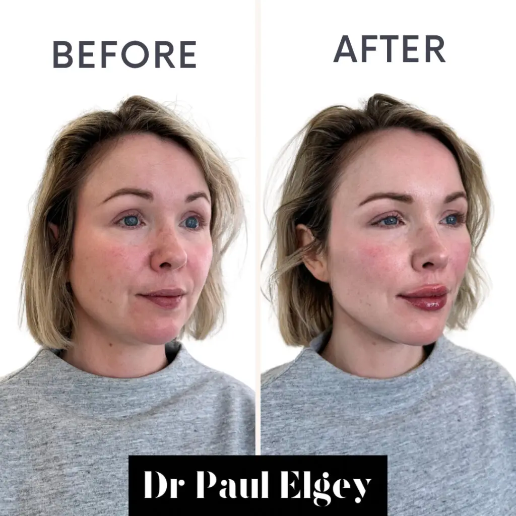 Midface filler treatment London before and after image. Cheek Filler