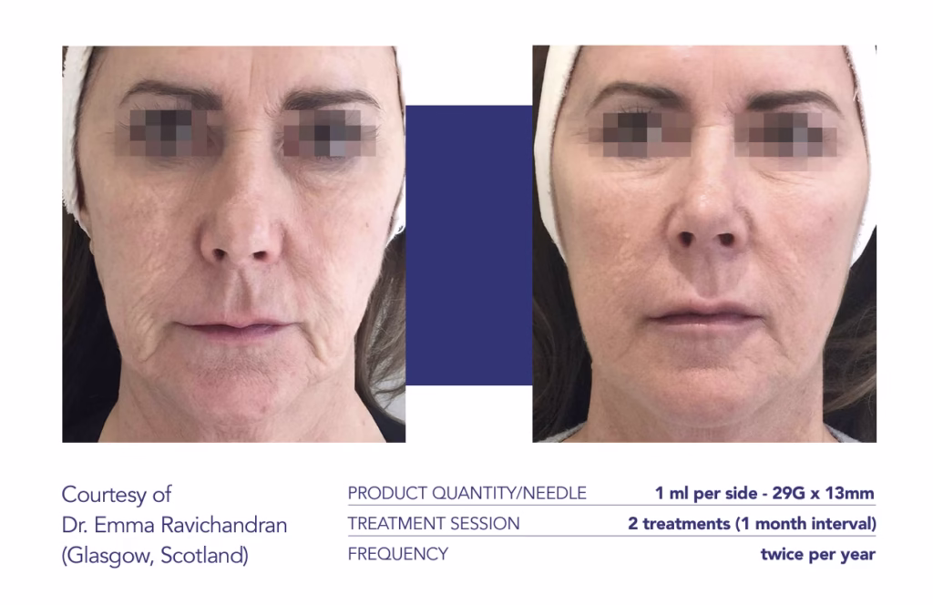 Screenshot 2025-02-05 at 13.07.18 Profhilo before and after - Skin rejuvenation and hydration